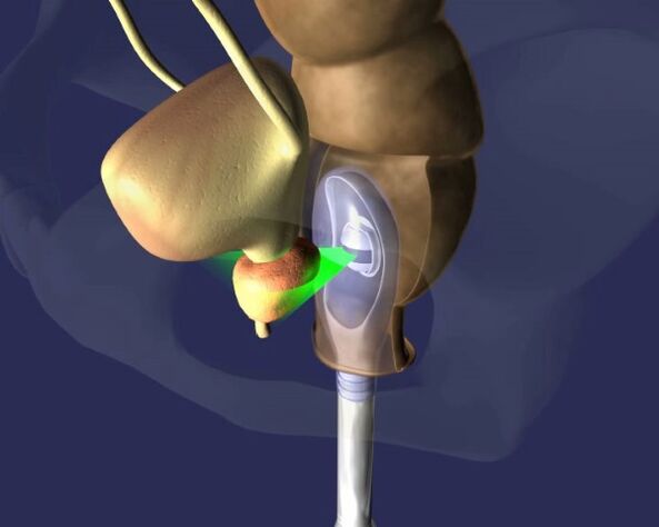 gli effetti degli ultrasuoni sulla prostata nella prostatite