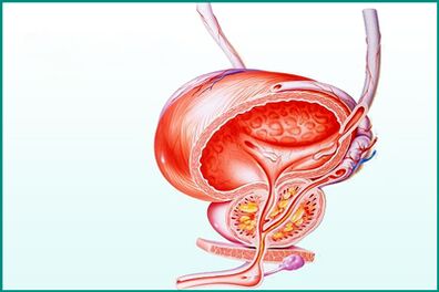 L'infiammazione della prostata nella prostatite acuta rappresenta una restrizione durante il rapporto sessuale