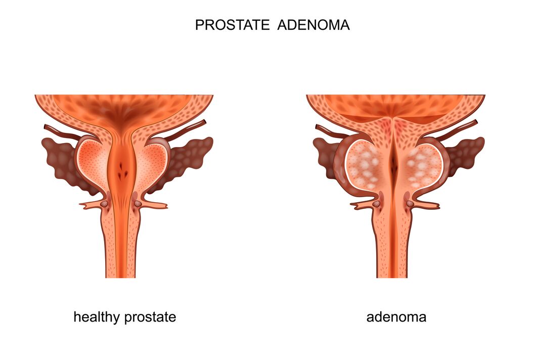 prostata sana e con adenomi